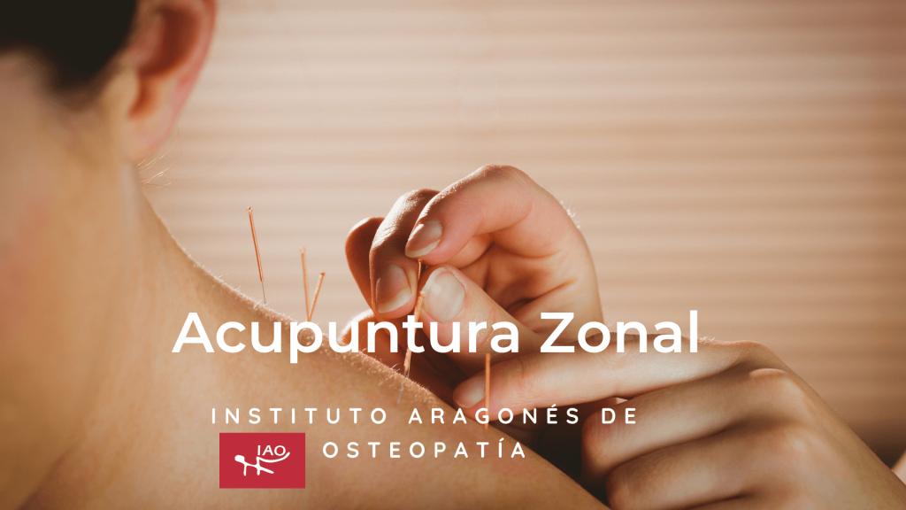 Acupuntura por Zonas